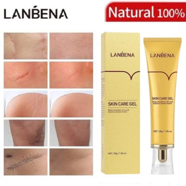 Lanbena TCM Scar and Acne Mark Removal Gel Ointment – 30gm শক্তিশালী দাগ ও অ্যাকনে মার্ক দূর করার সমাধান